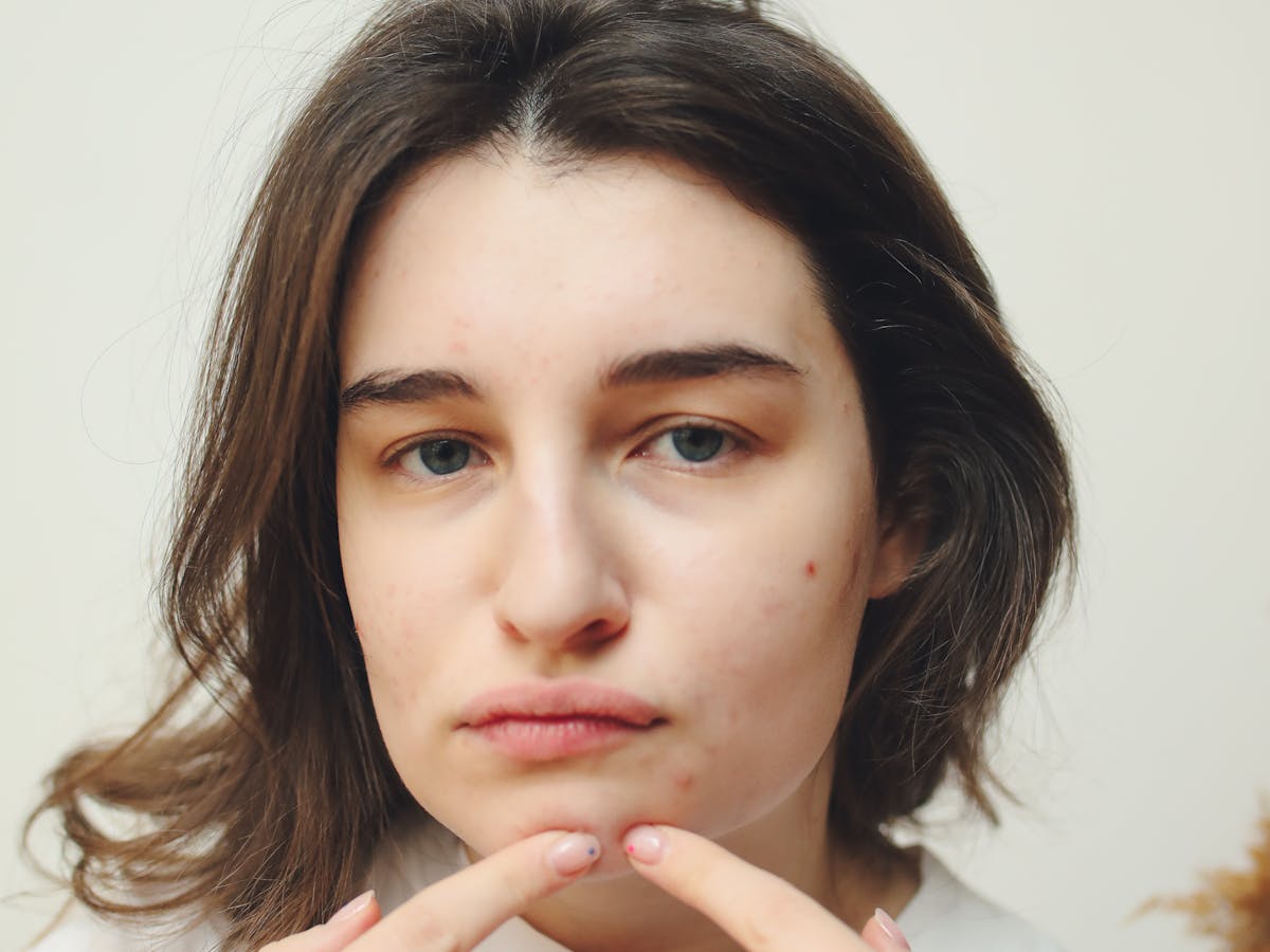 Tratamento de melasma