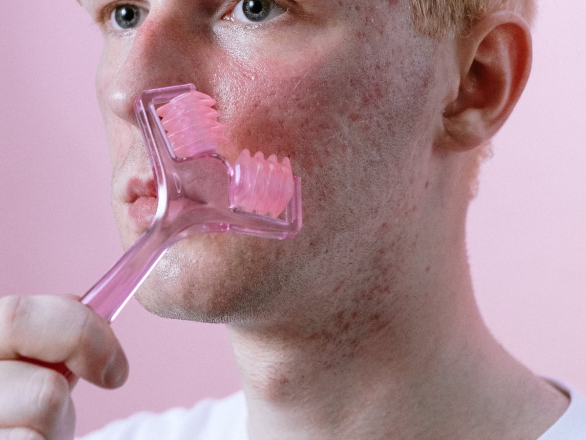 Microagulhamento facial